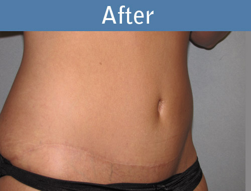 Before & After Photos  Abdominoplasty Surgery Gallery Milwaukee