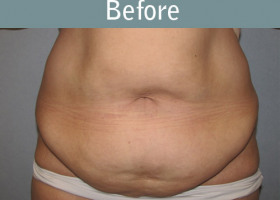 Milwaukee Plastic Surgery - Abdominoplasty - Tummy Tuck - 0-1