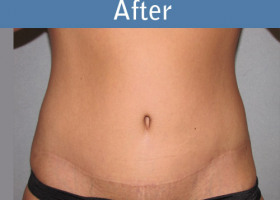 Milwaukee Plastic Surgery - Abdominoplasty - Tummy Tuck - 0-2