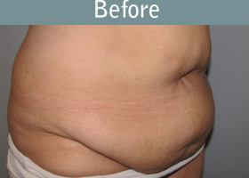 Milwaukee Plastic Surgery - Abdominoplasty - Tummy Tuck - 0-3
