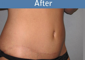 Milwaukee Plastic Surgery - Abdominoplasty - Tummy Tuck - 0-4
