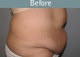 Milwaukee Plastic Surgery - Abdominoplasty - Tummy Tuck - 0-5