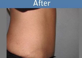 Milwaukee Plastic Surgery - Abdominoplasty - Tummy Tuck - 0-6