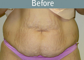Milwaukee Plastic Surgery - Abdominoplasty - Tummy Tuck - 1-1