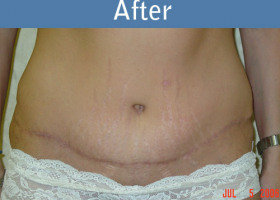 Milwaukee Plastic Surgery - Abdominoplasty - Tummy Tuck - 1-2