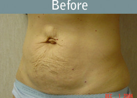 Milwaukee Plastic Surgery - Abdominoplasty - Tummy Tuck - 10-1
