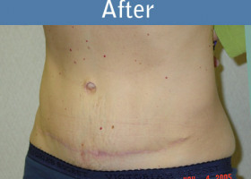 Milwaukee Plastic Surgery - Abdominoplasty - Tummy Tuck - 10-2