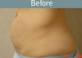 Milwaukee Plastic Surgery - Abdominoplasty - Tummy Tuck - 11-1