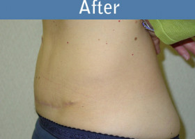 Milwaukee Plastic Surgery - Abdominoplasty - Tummy Tuck - 11-2