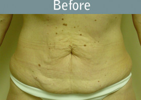 Milwaukee Plastic Surgery - Abdominoplasty - Tummy Tuck - 12-1