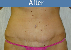 Milwaukee Plastic Surgery - Abdominoplasty - Tummy Tuck - 12-2