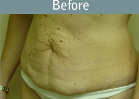 Milwaukee Plastic Surgery - Abdominoplasty - Tummy Tuck - 13-1