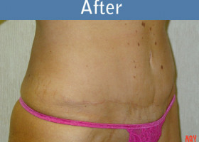 Milwaukee Plastic Surgery - Abdominoplasty - Tummy Tuck - 13-2
