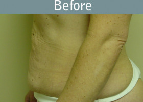Milwaukee Plastic Surgery - Abdominoplasty - Tummy Tuck - 14-1