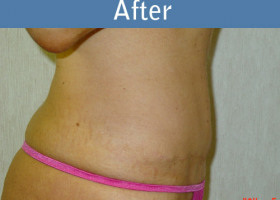 Milwaukee Plastic Surgery - Abdominoplasty - Tummy Tuck - 14-2