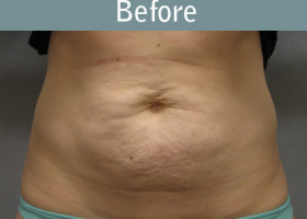 Milwaukee Plastic Surgery - Abdominoplasty - Tummy Tuck - 15-1