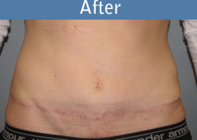 Milwaukee Plastic Surgery - Abdominoplasty - Tummy Tuck - 15-2