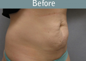 Milwaukee Plastic Surgery - Abdominoplasty - Tummy Tuck - 16-1