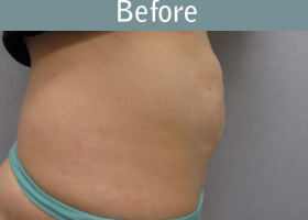 Milwaukee Plastic Surgery - Abdominoplasty - Tummy Tuck - 17-1