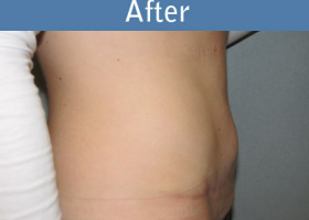 Milwaukee Plastic Surgery - Abdominoplasty - Tummy Tuck - 17-2