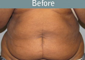 Milwaukee Plastic Surgery - Abdominoplasty - Tummy Tuck - 18-1