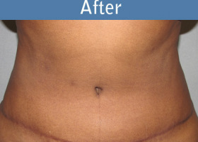 Milwaukee Plastic Surgery - Abdominoplasty - Tummy Tuck - 18-2