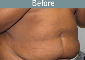 Milwaukee Plastic Surgery - Abdominoplasty - Tummy Tuck - 19-1