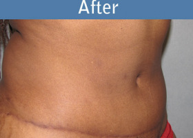 Milwaukee Plastic Surgery - Abdominoplasty - Tummy Tuck - 19-2