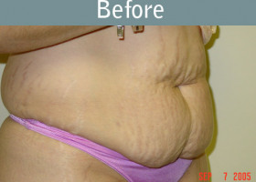 Milwaukee Plastic Surgery - Abdominoplasty - Tummy Tuck - 2-1
