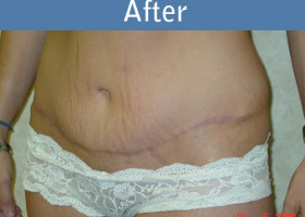 Milwaukee Plastic Surgery - Abdominoplasty - Tummy Tuck - 2-2