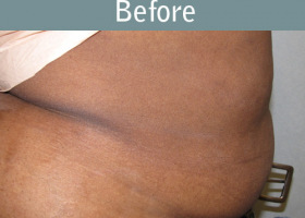 Milwaukee Plastic Surgery - Abdominoplasty - Tummy Tuck - 20-1