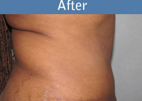Milwaukee Plastic Surgery - Abdominoplasty - Tummy Tuck - 20-2