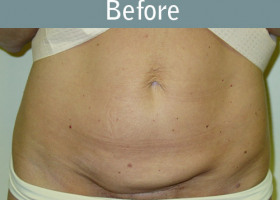 Milwaukee Plastic Surgery - Abdominoplasty - Tummy Tuck - 24-1