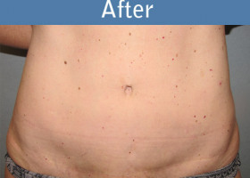 Milwaukee Plastic Surgery - Abdominoplasty - Tummy Tuck - 24-2