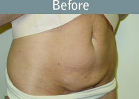 Milwaukee Plastic Surgery - Abdominoplasty - Tummy Tuck - 25-1