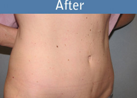 Milwaukee Plastic Surgery - Abdominoplasty - Tummy Tuck - 25-2