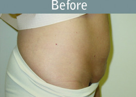 Milwaukee Plastic Surgery - Abdominoplasty - Tummy Tuck - 26-1