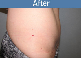 Milwaukee Plastic Surgery - Abdominoplasty - Tummy Tuck - 26-2