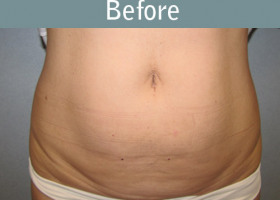 Milwaukee Plastic Surgery - Abdominoplasty - Tummy Tuck - 27-1