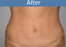 Milwaukee Plastic Surgery - Abdominoplasty - Tummy Tuck - 27-2