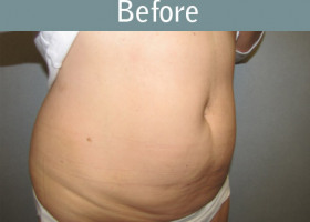Milwaukee Plastic Surgery - Abdominoplasty - Tummy Tuck - 27-3