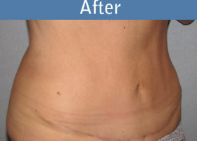 Milwaukee Plastic Surgery - Abdominoplasty - Tummy Tuck - 27-4