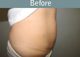Milwaukee Plastic Surgery - Abdominoplasty - Tummy Tuck -27-5