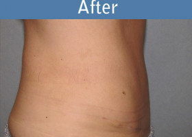 Milwaukee Plastic Surgery - Abdominoplasty - Tummy Tuck - 27-6