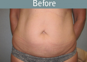 Milwaukee Plastic Surgery - Abdominoplasty - Tummy Tuck - 28-1
