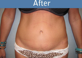 Milwaukee Plastic Surgery - Abdominoplasty - Tummy Tuck - 28-2