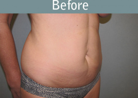Milwaukee Plastic Surgery - Abdominoplasty - Tummy Tuck - 28-3