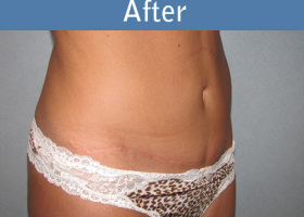 Milwaukee Plastic Surgery - Abdominoplasty - Tummy Tuck - 28-4