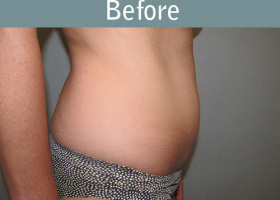 Milwaukee Plastic Surgery - Abdominoplasty - Tummy Tuck - 28-5