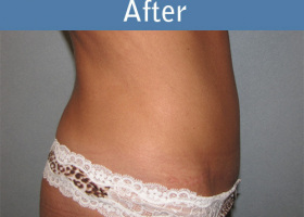 Milwaukee Plastic Surgery - Abdominoplasty - Tummy Tuck - 28-6